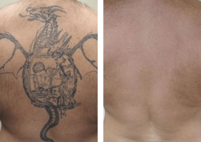 Tattoo lasering before and after