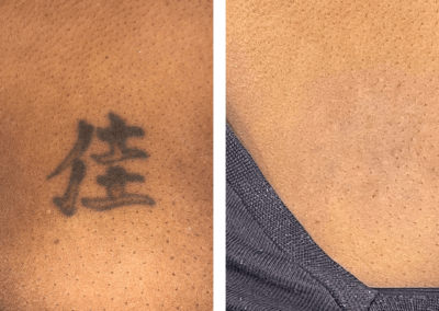 Tattoo laseren voor en na
