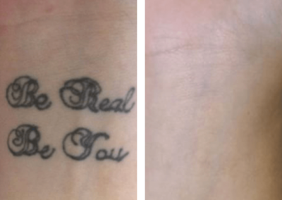 Tattoo lasering before and after