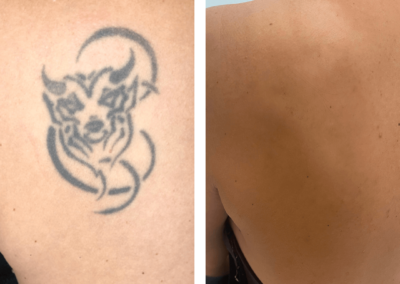 tattoo laser before and after