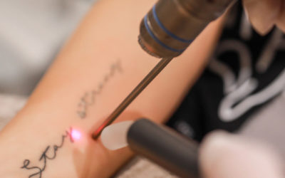 Aftercare tattoo lasering