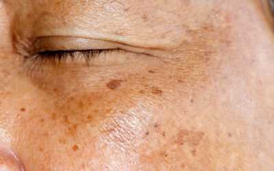 What to do about pigmentation spots