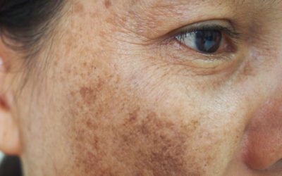 What to do about age spots