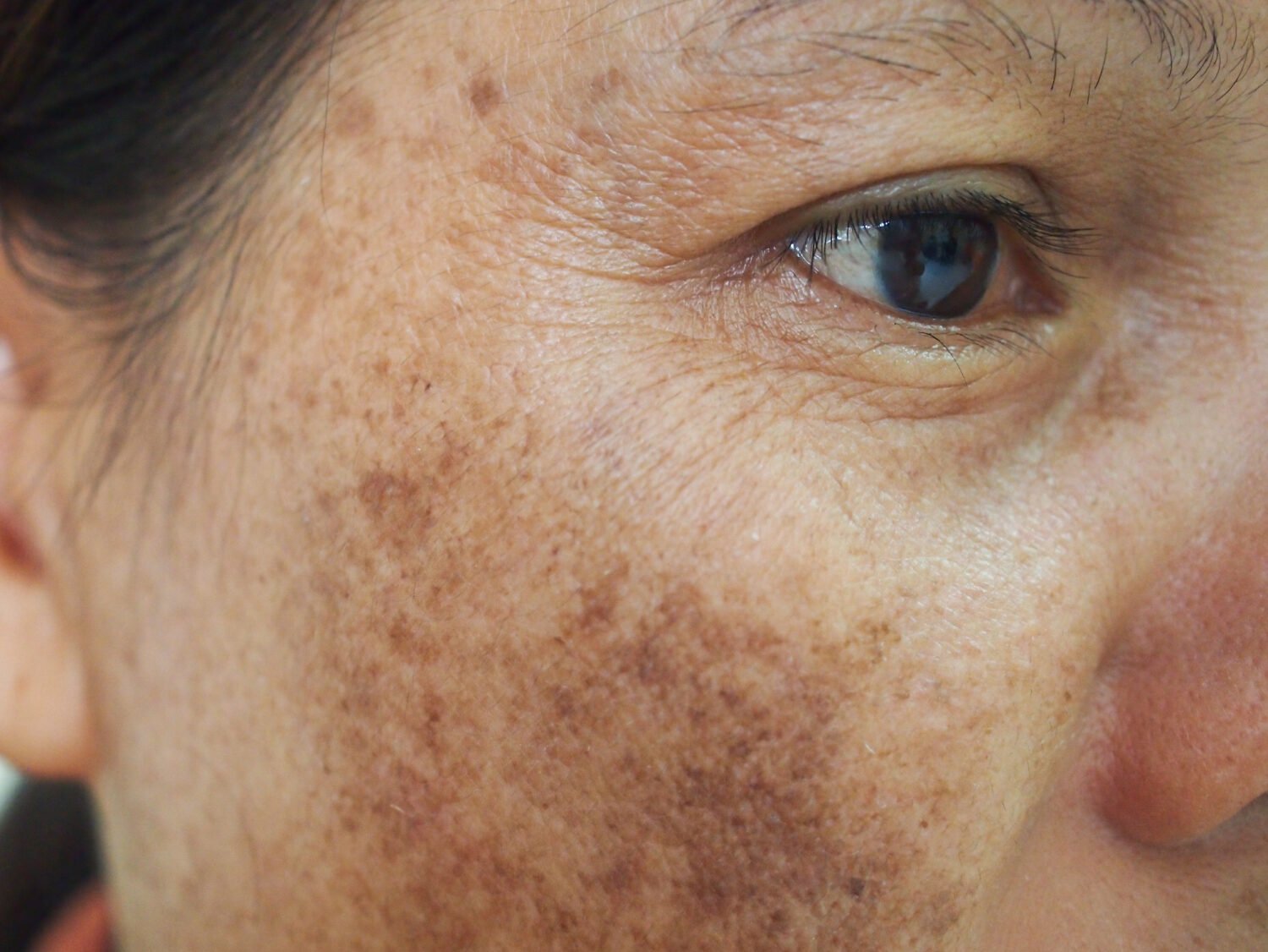 Wat Te Doen Tegen Ouderdomsvlekken New Skin Laserclinic