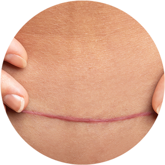 New-Skin-LaserClinic_540x540_Littekens_001