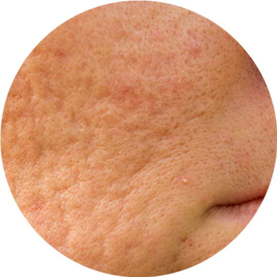 New-Skin-LaserClinic_540x540_Littekens_003