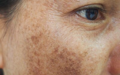 Ouderdomsvlekken verwijderen