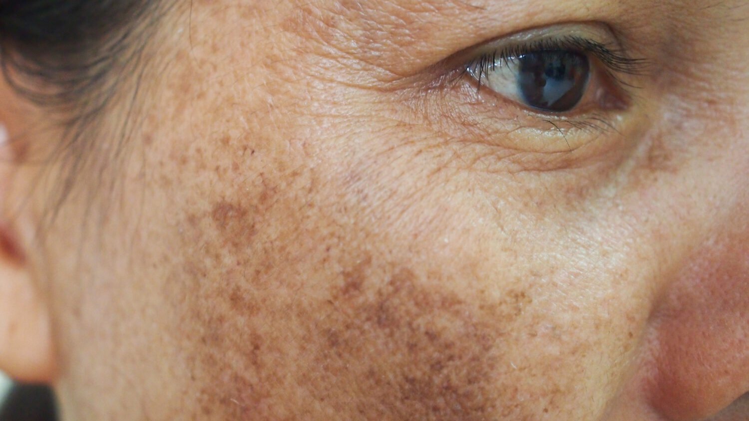 Ouderdomsvlekken verwijderen cover