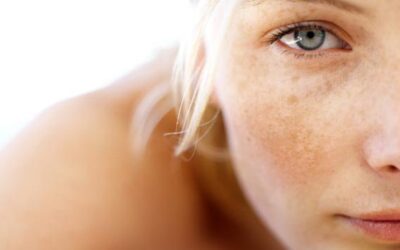 Hyperpigmentatie behandeling