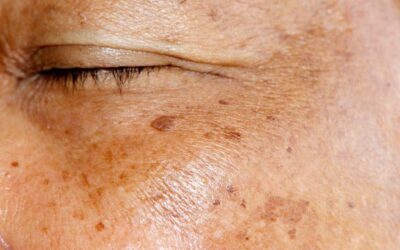 Ouderdomsvlekken laseren