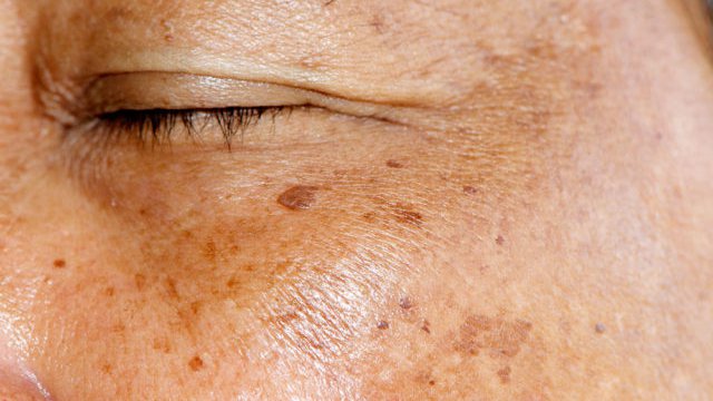 Ouderdomsvlekken laseren cover