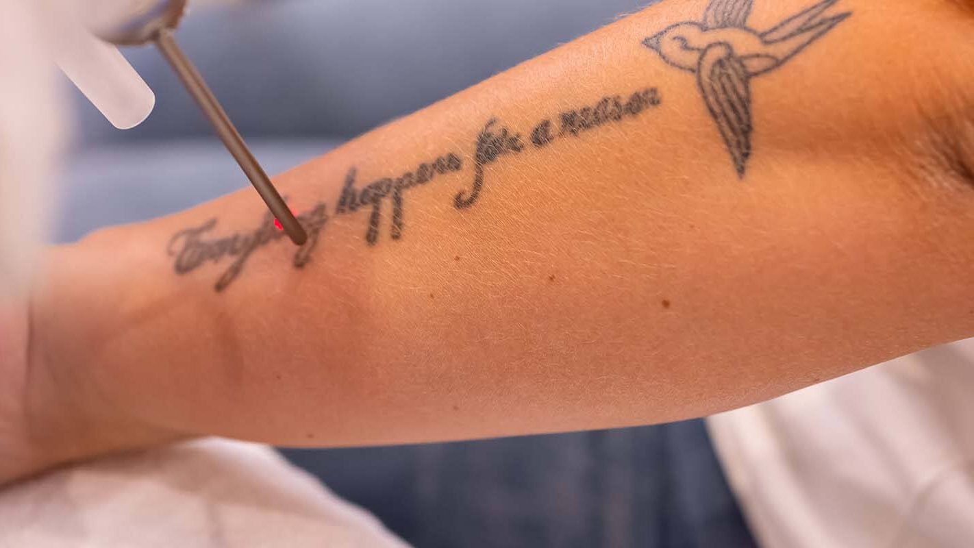 Tattoo verwijderen, hoe werkt het? cover