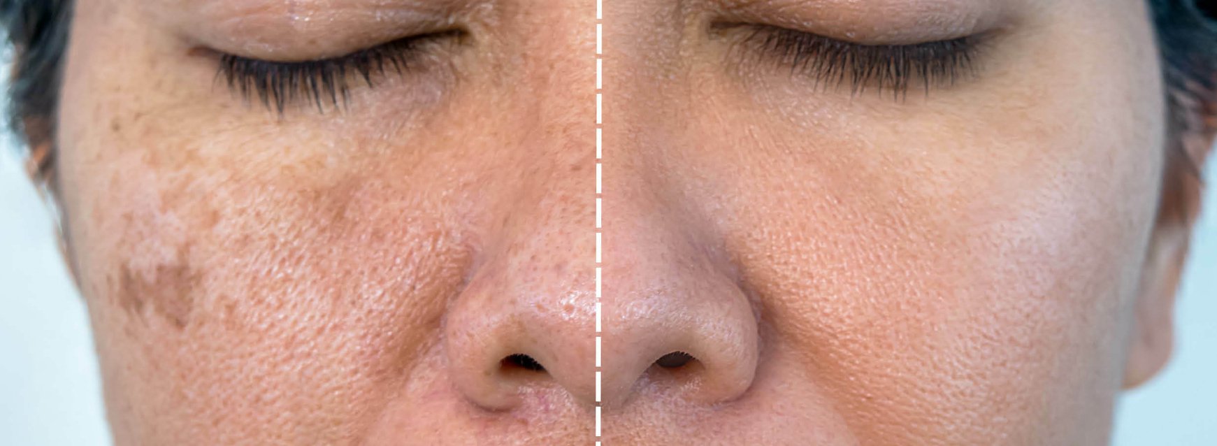 Pigmentvlekken in het gezicht | Oorzaken, soorten, behandeling & preventie cover