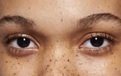 Pigmentvlekken in het gezicht | Oorzaken, soorten, behandeling & preventie