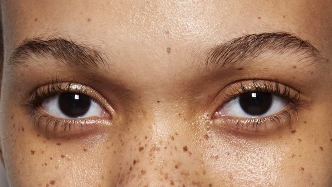 Pigmentvlekken in het gezicht | Oorzaken, soorten, behandeling & preventie cover