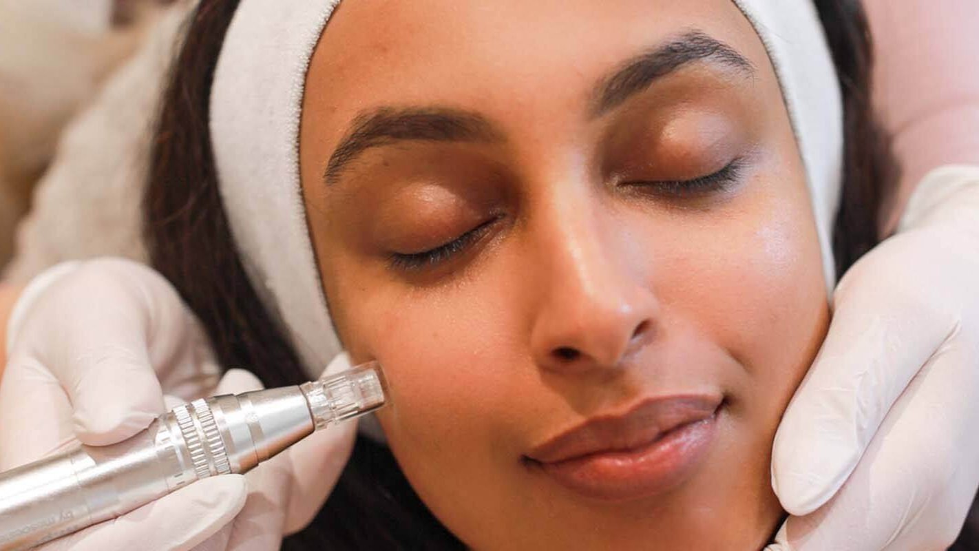Microneedling behandeling cover